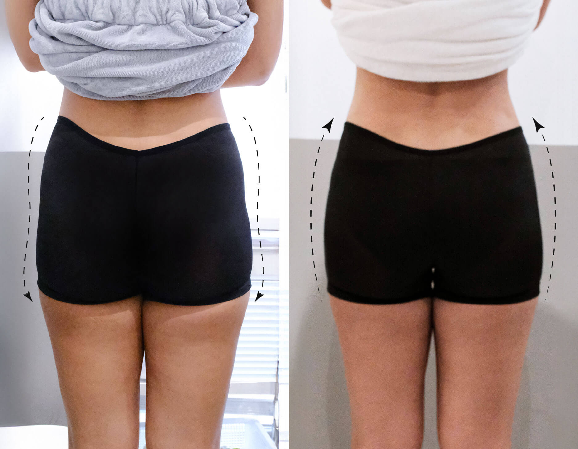 案例分享-小腹馬鞍-阿布舞