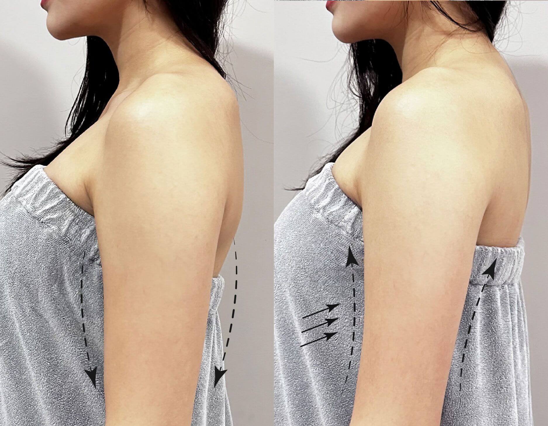 案例分享-手臂-熊霓