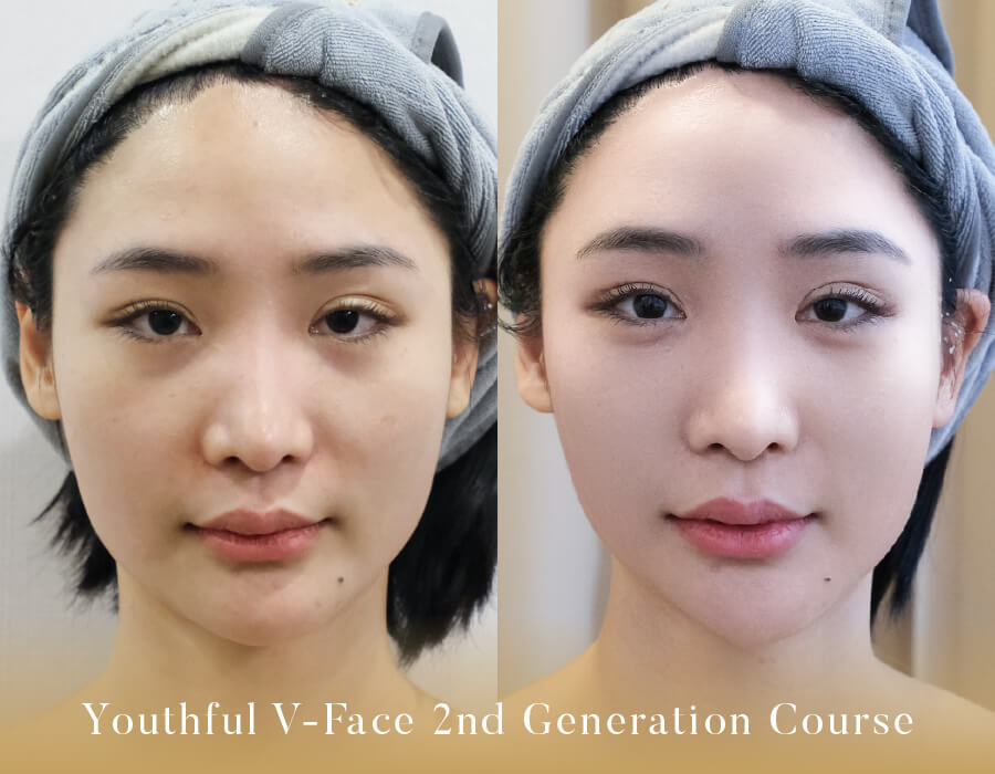 案例分享-童顏V臉二代-小貓