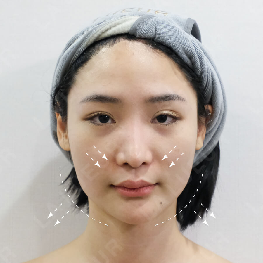 案例分享-童顏V臉二代-小貓