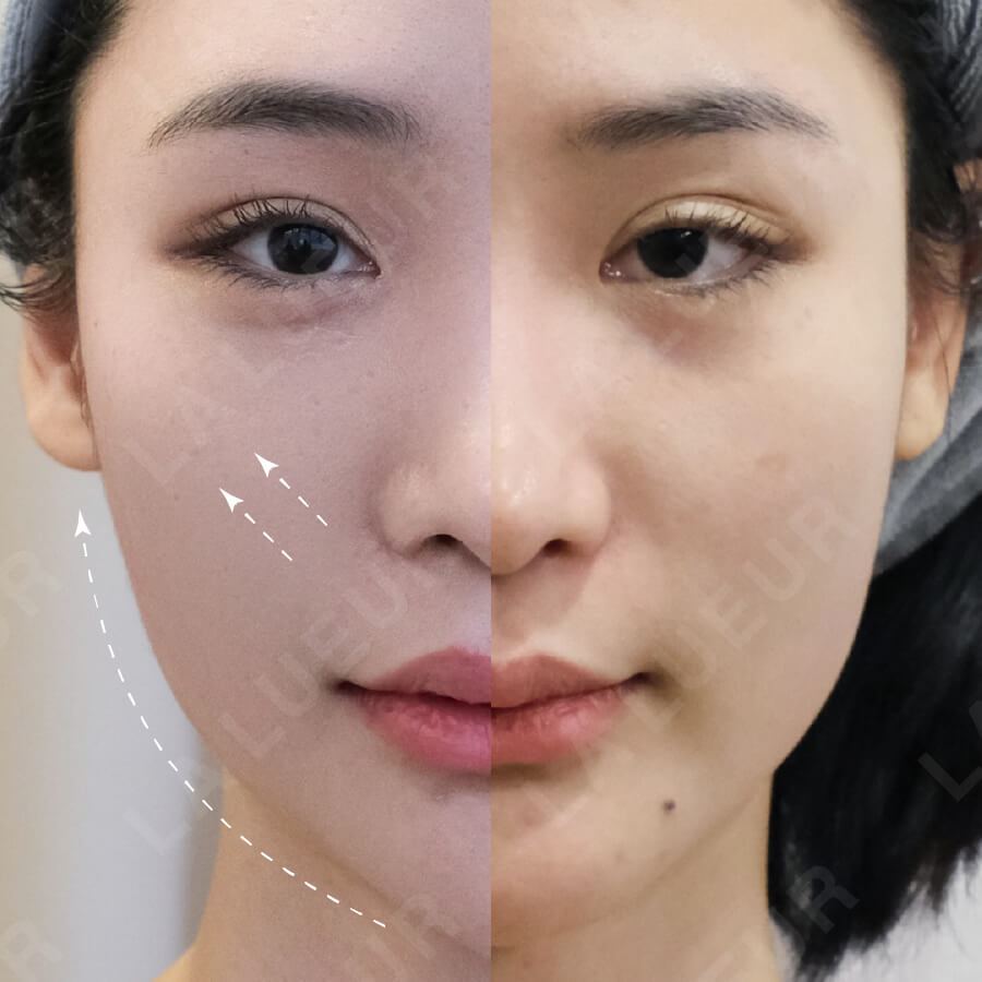 案例分享-童顏V臉二代-小貓