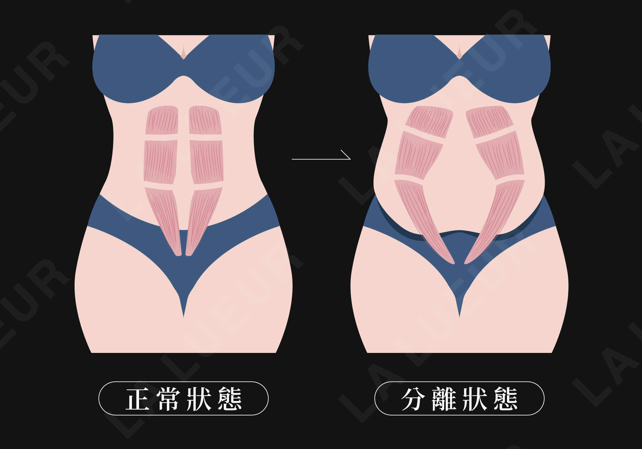 美學新知-產後肚皮鬆弛